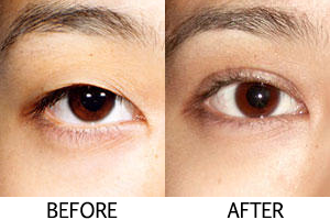 double_eyelid_surgery1.png